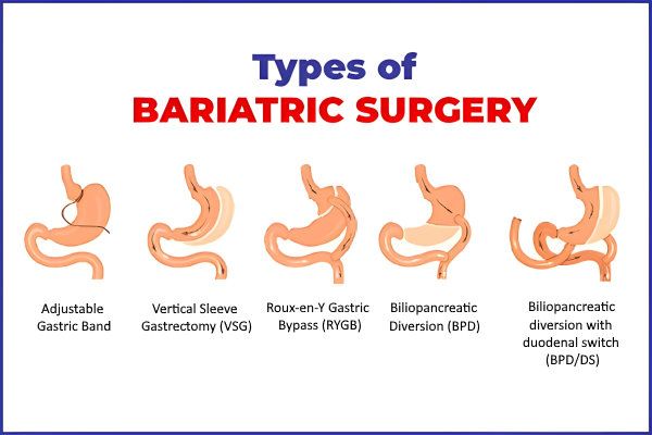 apa-itu-bariatric-surgery