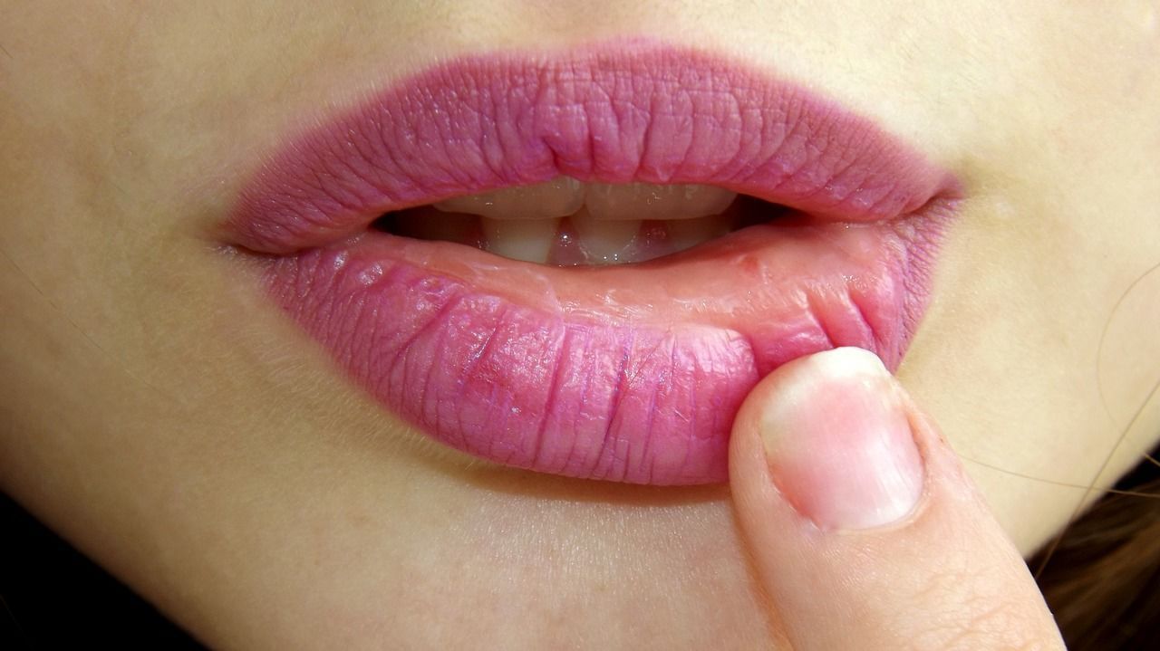5. Bibir pecah-pecah lidah bengkak