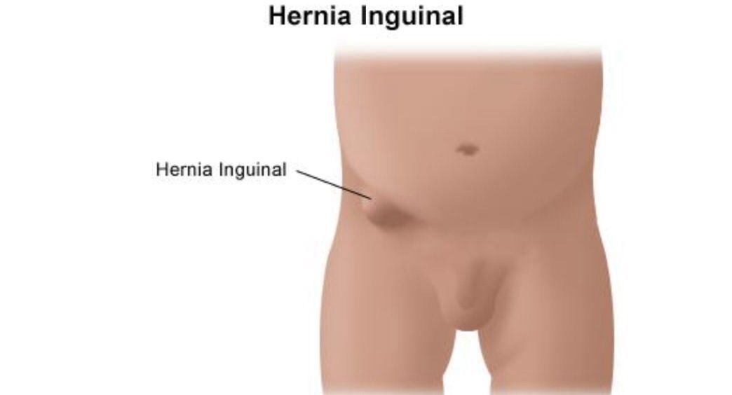Hernia pada alat kelamin biasanya dapat terlihat jelas di bagian kelamin seperti benjolan, dan akan lebih jelas terlihat jika si Kecil menangis.
