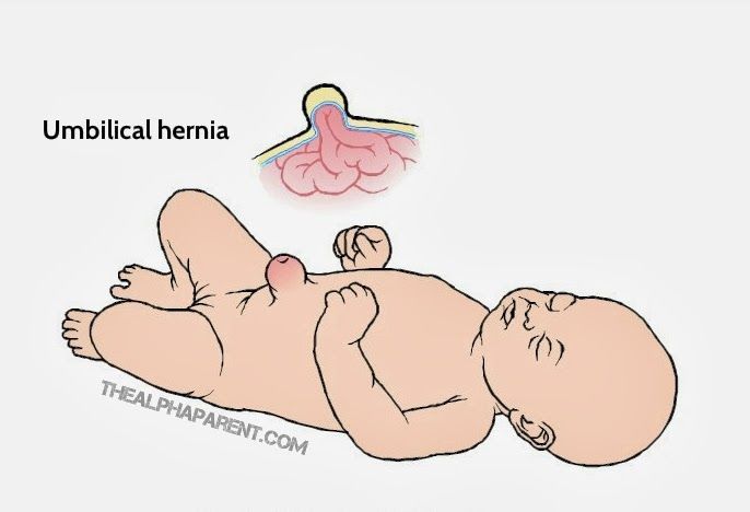 Hernia pada bayi berikut ini, sering muncul pada bayi perempuan, ini terjadi karena otot-otot perut pada bayi belum menutup secara sempurna dan meninggalkan celah.