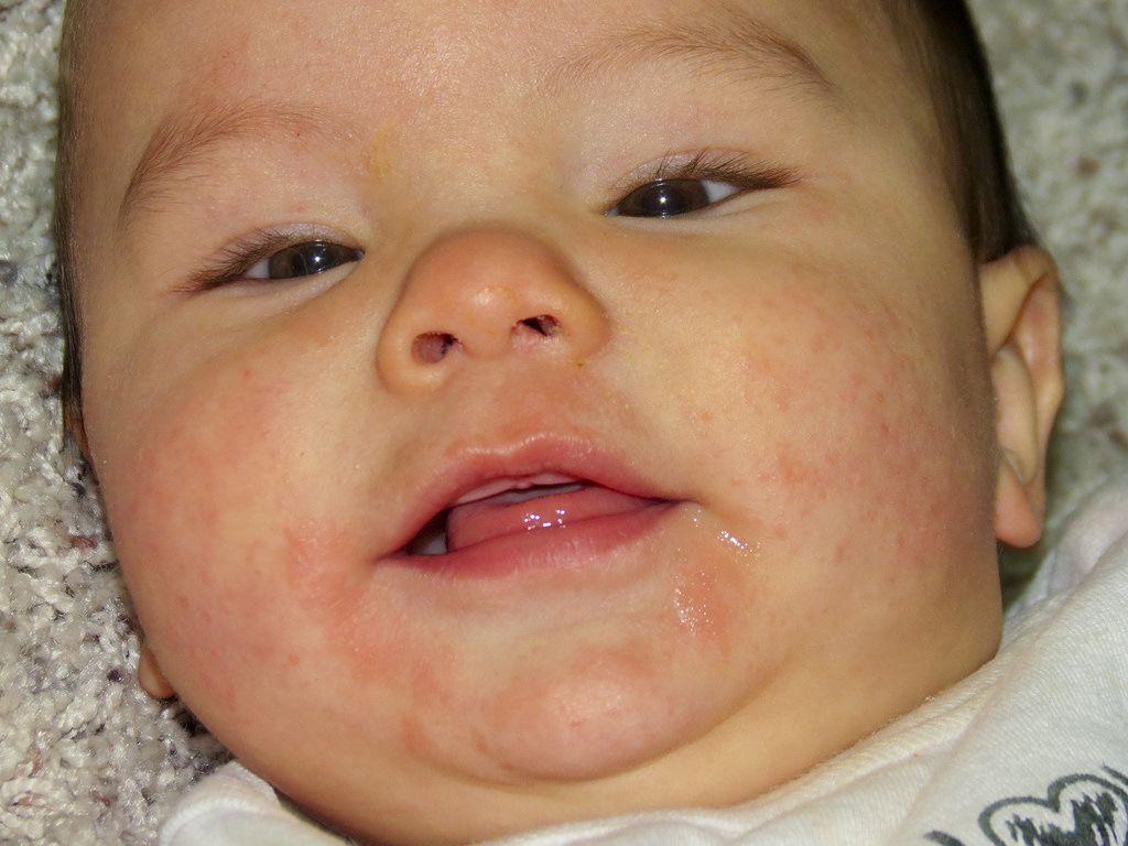 Penyebab Bayi Alergi Susu Sapi