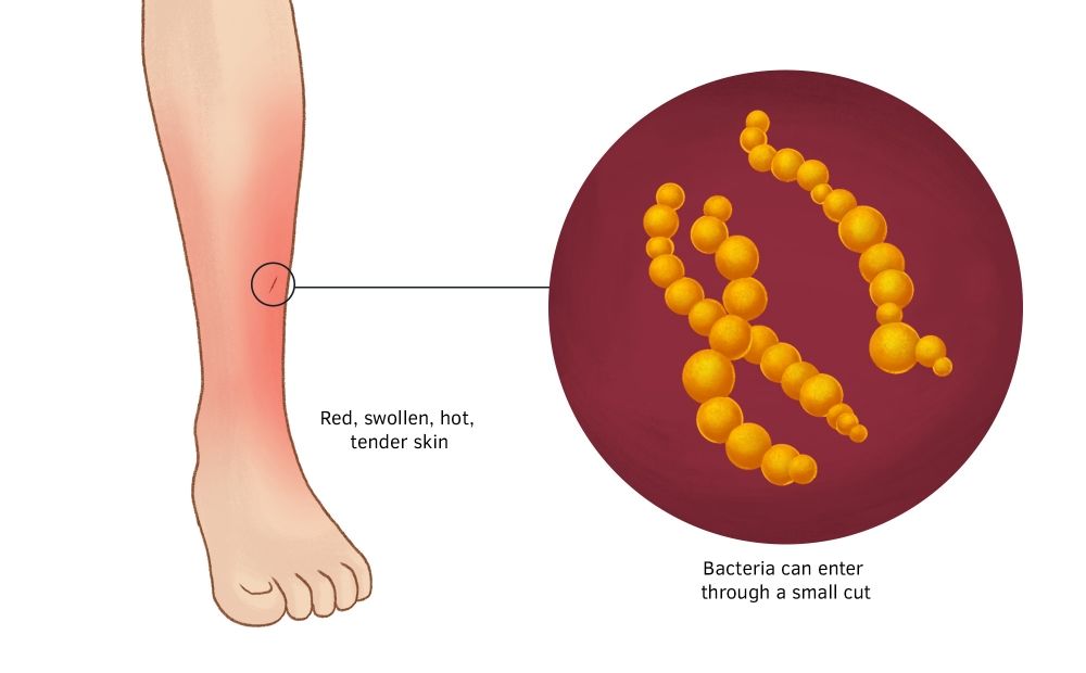 Selulitis adalah Serangan Bakteri