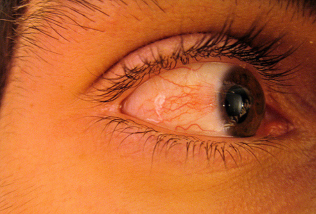 3. Apa ciri-ciri pengidap glaucoma