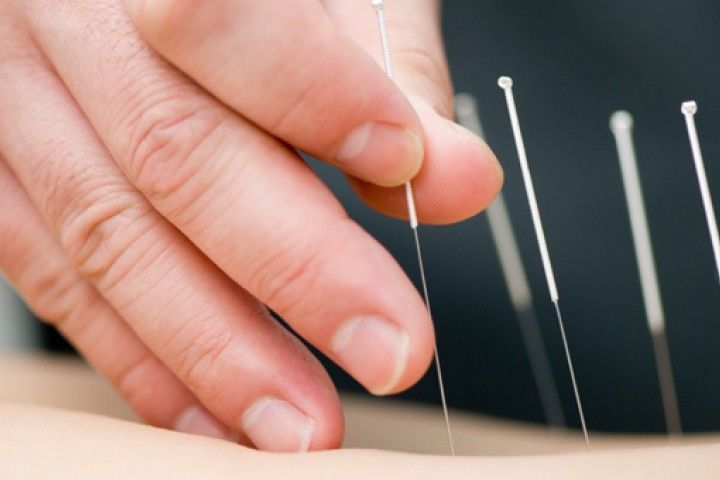 4. Melakukan terapi akupunktur