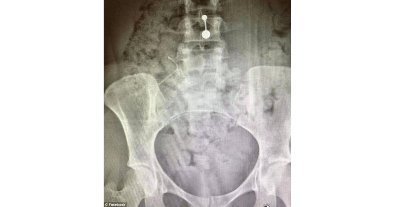 IUD Terpasang Menghilang