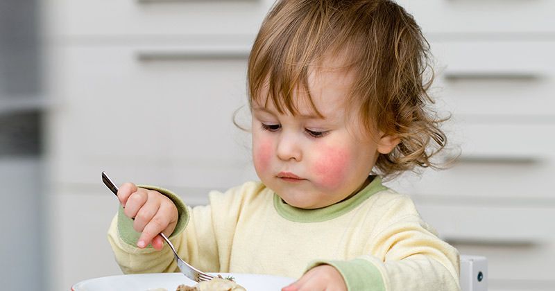 5. Anak alergi asupan makanannya 