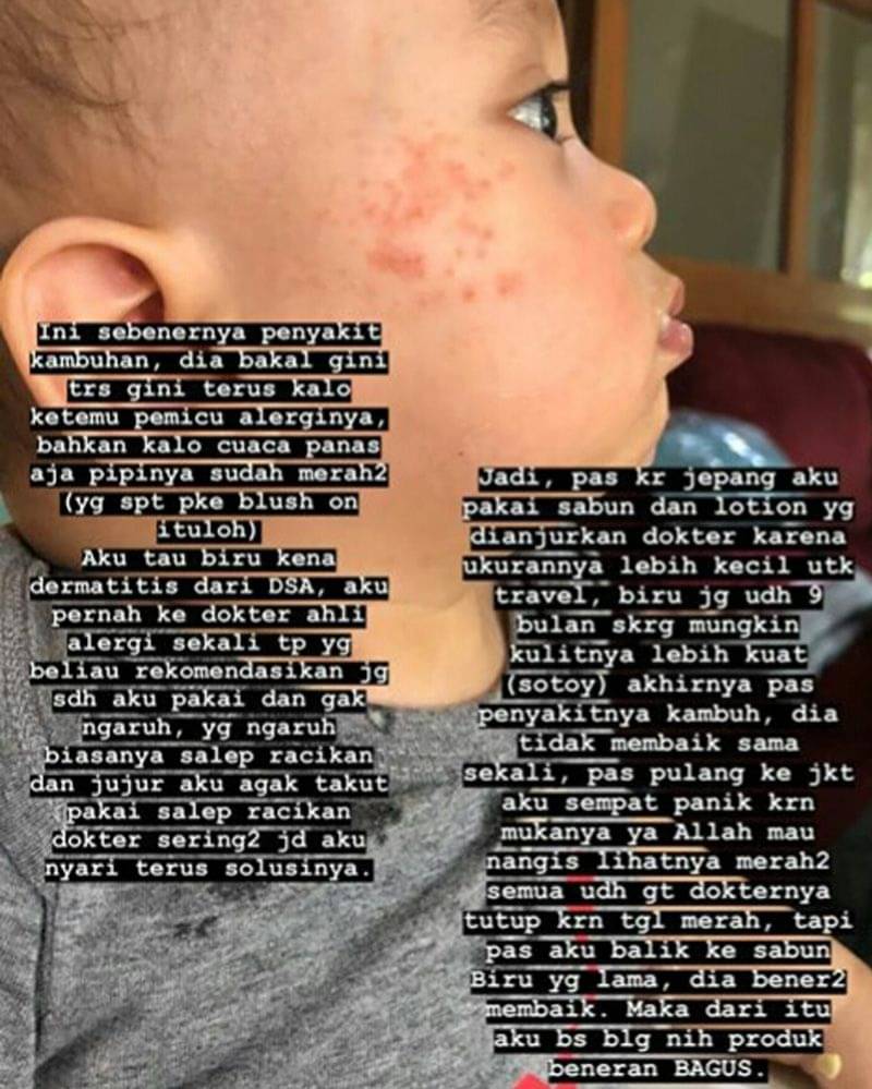 Penyebab Dermatitis Atopik Dialami Xabiru Bayi Rachel Vennya