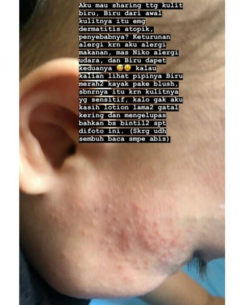 Penyebab Dermatitis Atopik Dialami Xabiru Bayi Rachel Vennya