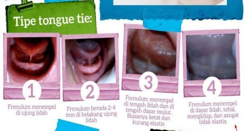 3. Tanda-tanda anak memiliki lip tie tounge tie