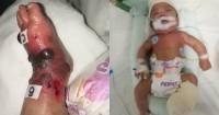Komplikasi Transfusi Darah, Kaki Bayi 4 Bulan Ini Harus Diamputasi