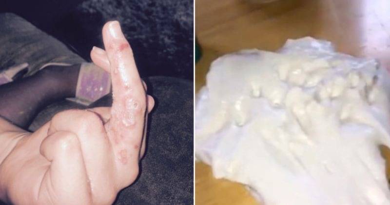 Anak 9 Tahun Alami Luka Bakar Di Tangan Usai Membuat Slime