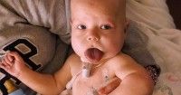 Menyedihkan, Seorang Bayi Usia 16 Bulan Hidup Lidah Terjulur