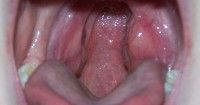 6. Mengatasi penyakit tonsilitis