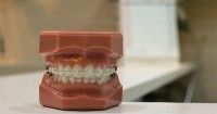2. Masalah karies gigi