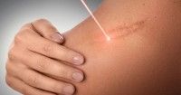 1. Menghilangkan stretch mark payudara perawatan laser khusus