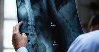 Demi Menjaga Kesehatan Tulang, Kenali Penyebab Umum Osteoporosis