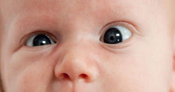 Mata Juling pada Bayi: Penyebab dan Gejalanya | Popmama.com