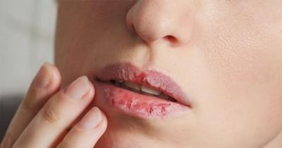 8 Cara Ampuh Mengatasi Bibir Kering saat Puasa, Terapkan Yuk