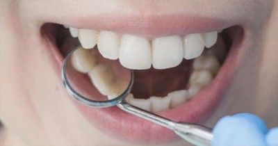 Kenali Penyebab Karang Gigi dan Cara Mengatasinya