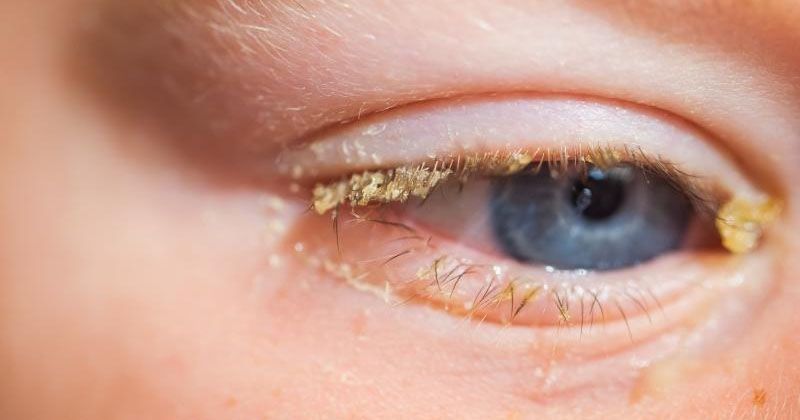 Obat sakit mata anak belekan