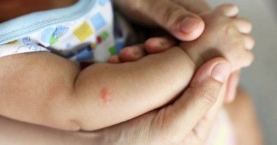 Awas Ini 6 Jenis Penyakit Kulit Bayi Sering Dijumpai