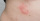 2. Pruritic urticarial papules and plaques of pregnancy (PUPPP)