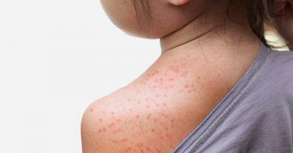 Alergi obat pada kulit