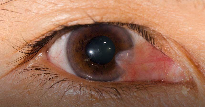 5. Tumbuh jaringan mata atau pterygium