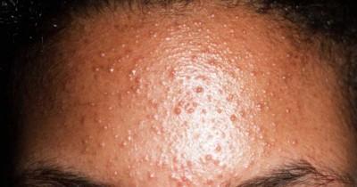Fungal Acne pada Remaja, bukan Jerawat Tapi Jamur