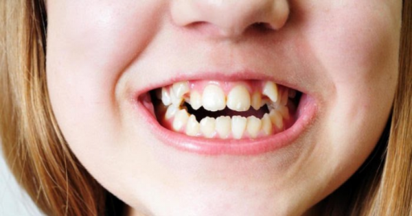 Cara senyum untuk gigi tonggos