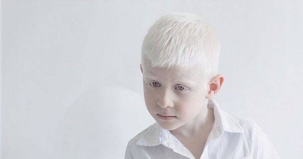 Apa itu albino