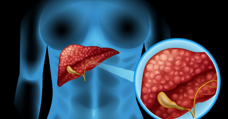 Hari Hepatitis Sedunia, Ini 7 Fakta Penyebab Penyakit Hati | Popmama.com