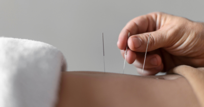 Benarkah Terapi Akupunktur Bisa Bikin Cepat Hamil?