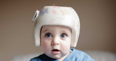 Mengenal Cranial Helmet, Helm untuk Terapi Kepala Bayi yang Peyang