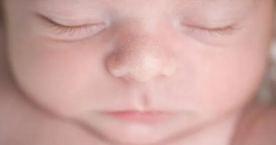 Milia pada Bayi Baru Lahir: Penyebab dan Perawatannya