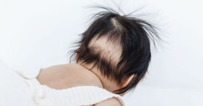 Penyebab Rambut Bayi Botak di Belakang dan Cara Mengatasinya