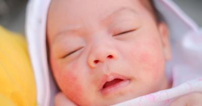 13 Penyebab Ruam Pipi Bayi Tak Kunjung Sembuh