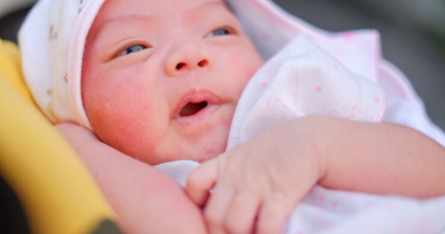 6 Cara Menghilangkan Bintik Merah Wajah Bayi Sesuai Jenisnya
