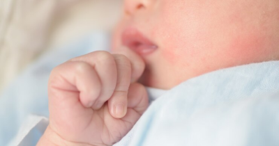 Biang Keringat Bayi Penyebab, Gejala Cara Mengatasinya