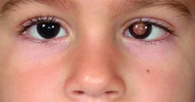 Kanker Mata pada Anak: Gejala, Penyebab, dan Pengobatannya