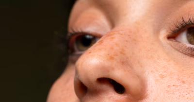 10 Cara Mengecilkan Pori-Pori di Wajah, Retinol Bisa Jadi Andalan!
